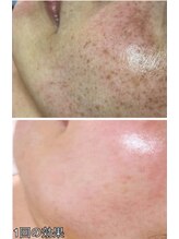 プリエ(Prier)/光フェイシャル