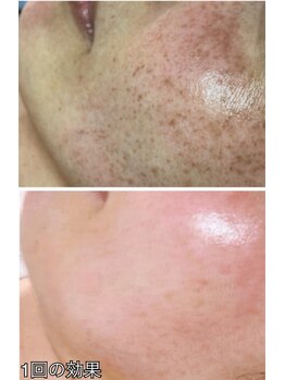 プリエ(Prier)/光フェイシャル