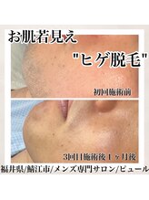 ピュール 鯖江店(PUR)/メンズ/眉毛/メンズ脱毛/脱毛