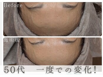 アルム(Areum)/眉間のシワや表面のザラつきが!!