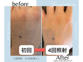 ユシェリア(Yucheria)/手指甲脱毛