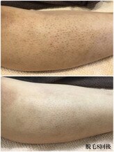 サニーハンド(Sunnyhand)/コンプレックス解消！！！