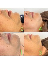 イースヘアーアンドビューティーショップ(ease hair&beauty shop)/髭脱毛経過