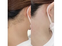 ネイル アンド アイラッシュ グレイス(Grace)/うなじのWAX脱毛