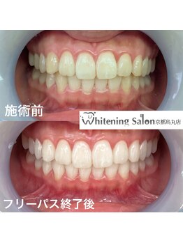 ホワイトニングサロン 京都烏丸店/ホワイトニング施術例