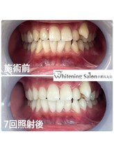 ホワイトニングサロン 京都烏丸店/ホワイトニング施術例