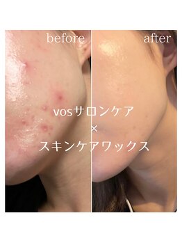 サロン ド ボーテ ラーンジュ 岐阜店(salon de beaut'e L'ange)/本気の肌改善毛穴、ニキビ、小顔