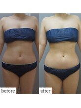 アップルミント/＜痩身＞before・after