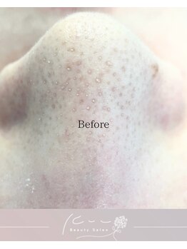 クウ(kuu)/【韓国式3D毛穴洗浄】Before