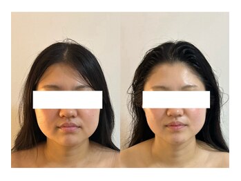 シアワセ(shiAwase)/【大阪本町】小顔矯正 B/A変化