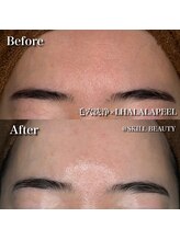スキル アイラッシュ(SKILL eyelash)/ララピール☆beforeafter