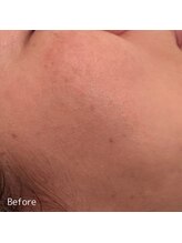 ククル(KUKULU)/陶肌トリートメントご来店時