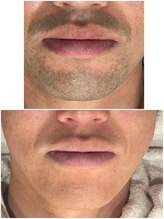 グロー(GLOW)/メンズ脱毛