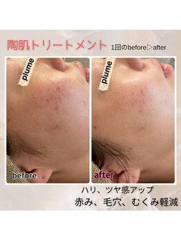 プルーム 久留米店(plume)/ハーブピーリング/ニキビケア