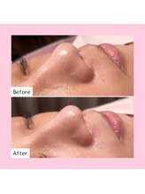 ホワイトラボ ライカム前店(White labo)/【施術例】毛穴洗浄ピーリング