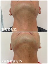 シャルム(Charme)/メンズヒゲ脱毛