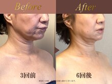 オーシャン(Ocean)/全身美容矯正120分/週1回×4回
