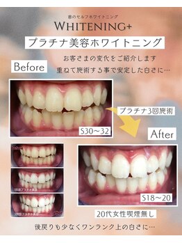 ホワイトニングプラス(Whitening+)/しっかり重ねていこう