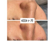 ビアラ(美ala)/毛穴汚れ解消/4回