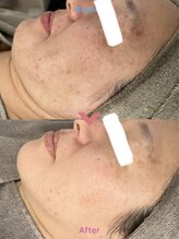 アレイズ(ARAYS)/症例(シミ、たるみ)