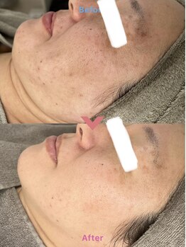 アレイズ(ARAYS)/症例(シミ、たるみ)