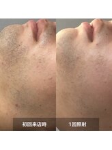 リムル(REMURU)/ひげ脱毛1回照射