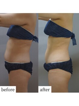 アップルミント/＜痩身＞before・after