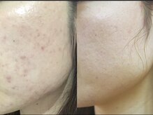 マリヴェリーテ(Mari verite)/とにかくニキビを改善したい