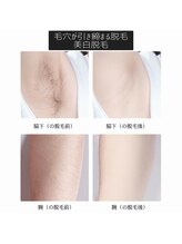 アモ 夢シティ新下関(AMO.)/美白LED脱毛"県内導入初"