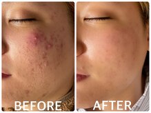 ハーブピーリング 恵比寿/ニキビケア