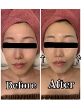 ブランシュール/炭酸カーボキシー×小顔タイト