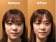 くにたちNyan鍼灸整体院/【小顔矯正】Before After 9