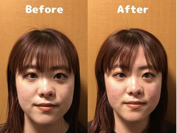 くにたちNyan鍼灸整体院/【小顔矯正】Before After 9