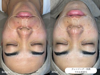 フォンビューティー(fon beauty)/ホームケア1回