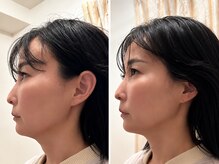 大矢野鍼灸サロンの雰囲気（美容鍼は全コース小顔矯正・首肩ほぐし・ヘッドスパ付きです。）