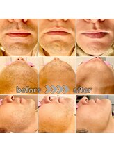 フィズ 経堂店(FIS)/☆ひげ脱毛完了☆［経堂/脱毛］