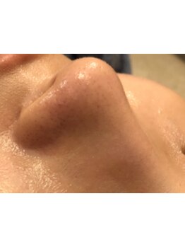 毛穴ケアをしたい