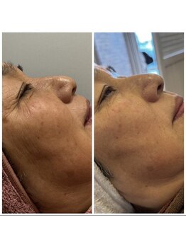 スターティス(STATICE)/ノアグロウフェイシャル