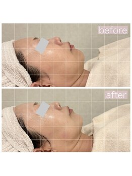 ペルラペティーユ(PERLA PETILLER)/3D輪郭形成リフティング