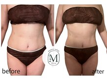 ミヨン(Miyong)/お腹スッキリ！　ボディ90分5回