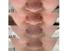 プラセル(Placer)の雰囲気（ハードなケアばかり頑張ってきた！ここで最後にすると決めて半年）