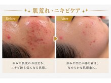 マインドエステ 仙台店(mindエステ)の雰囲気（ニキビ・肌荒れの原因である酸化を除去し、なめらかな肌へ導く◎）