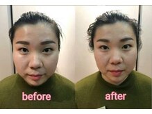 アゴラ/【小顔】【中国での実績もあり】