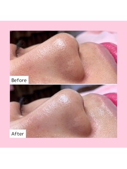 ホワイトラボ ライカム前店(White labo)/【施術例】毛穴洗浄ピーリング