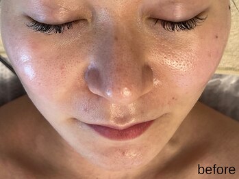 サロン ド エメ(salon de aimer)/【Before】毛穴の開き、赤みに♪