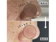 ムク(MUKU)/毛穴洗浄