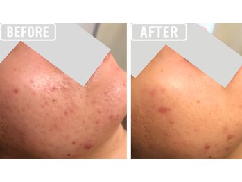 ビビ(VIVI)/ハーブピーリング症例