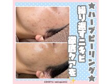 ホワイトアクア 岐阜店(WHITE AQUA)/ララピール/ハーブピーリング