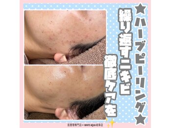 ホワイトアクア 岐阜店(WHITE AQUA)/ララピール/ハーブピーリング