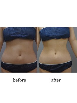 アップルミント/＜痩身＞before・after